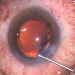 Implante de lente intraocular en sustitucion del cristalino