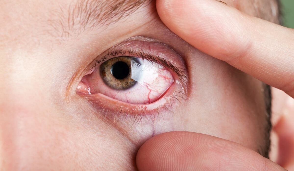 Descubre cómo afecta la alergia en los ojos | Ocumed