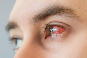 ¿Qué es la queratitis ocular y por qué se produce?