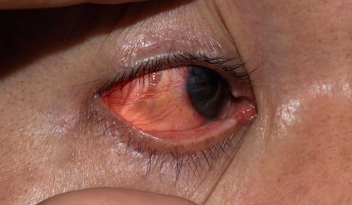 Queratitis Ocular Síntomas y Tratamiento