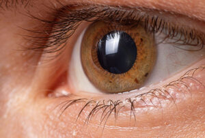 ¿Qué causa el melanoma en los ojos?