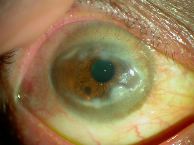 degeneración corneal tratamiento