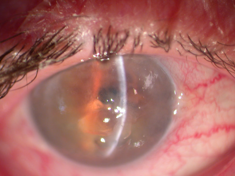 edema corneal tratamiento