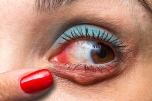 Blefaritis y menopausia