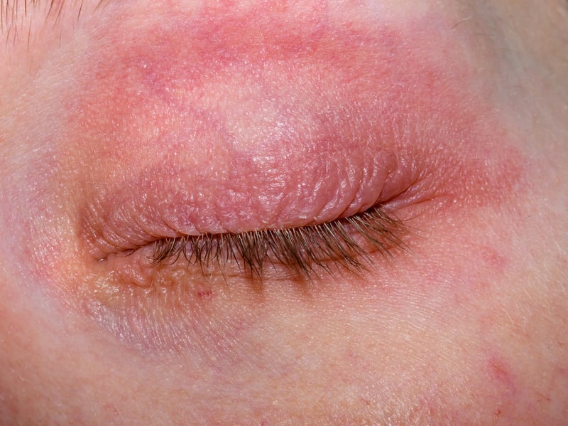rosácea ocular síntomas