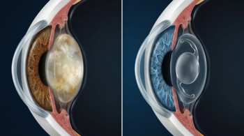 Comparativa de un ojo con catarata y un ojo tras la cirugía con lente intraocular implantada